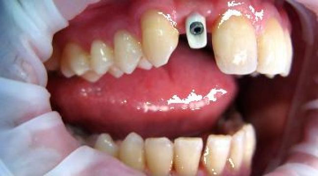 Implant dentar de la Medical Dental Blue Srl
