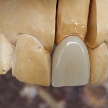 Coroana dentara integral ceramica Emax de la Orosz A.zoltan - Laborator Tehnica Dentara
