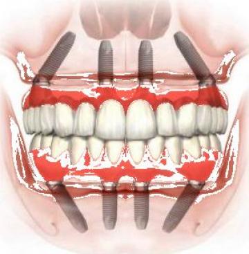 Implant dentar All on 4 si All on 6 de la Clinica Stomatologica Dental Premier